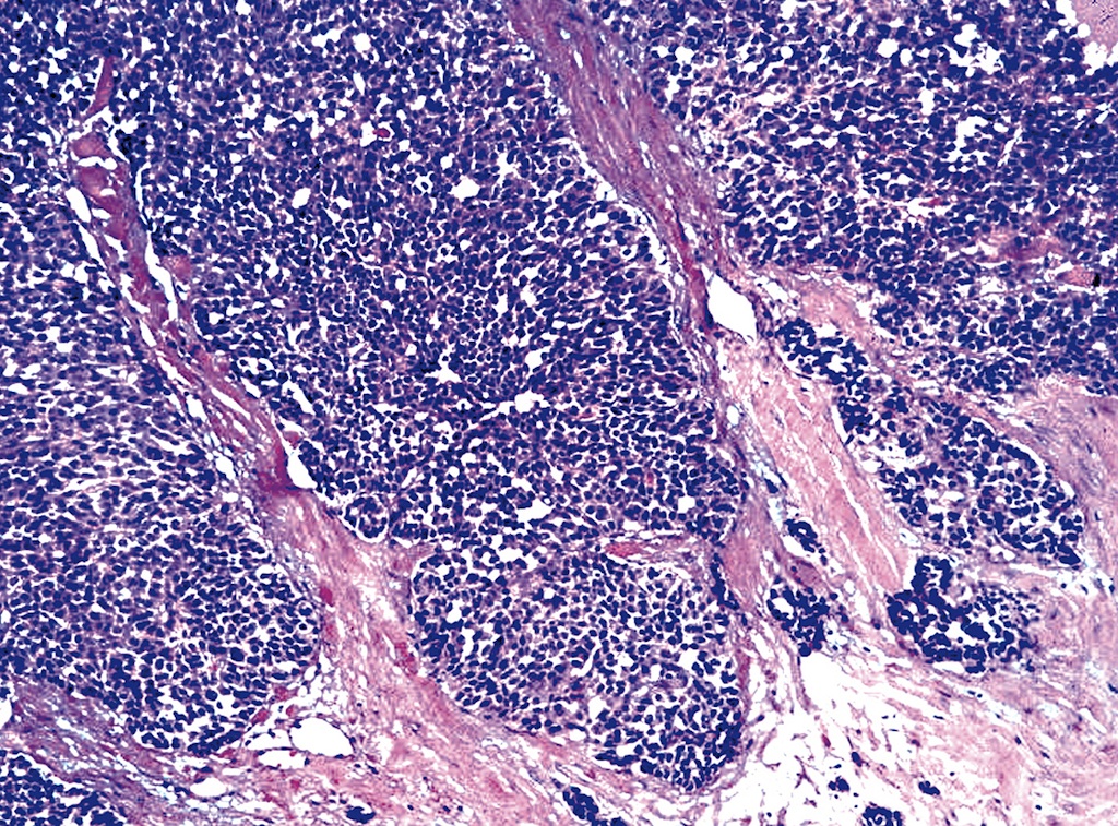 poorly-differentiated-carcinoma-pathology